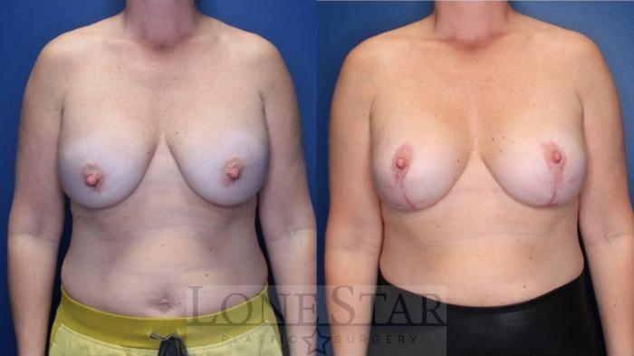 Before & After Breast Augmentation Case 169 Front View in Frisco, TX