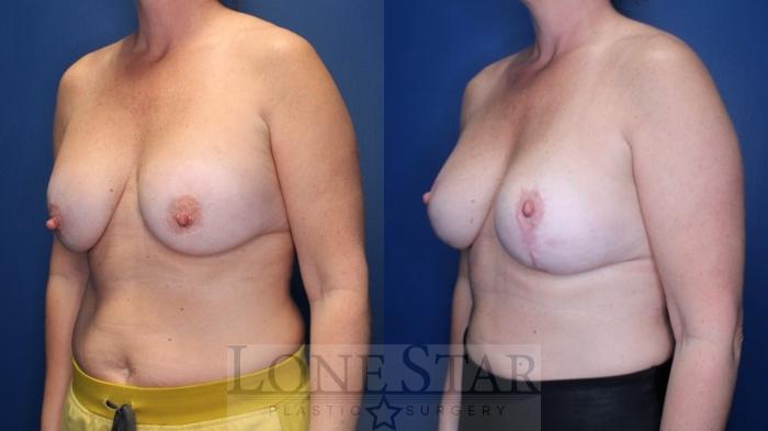 Before & After Breast Augmentation with Lift Case 169 Left Oblique View in Frisco, TX