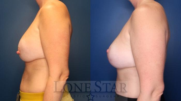 Before & After Breast Augmentation Revision Case 169 Left Side View in Frisco, TX