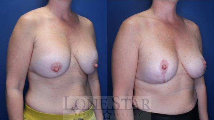 Before & After Breast Augmentation with Lift Case 169 Right Oblique View in Frisco, TX
