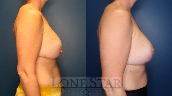 Before & After Breast Augmentation Revision Case 169 Right Side View in Frisco, TX