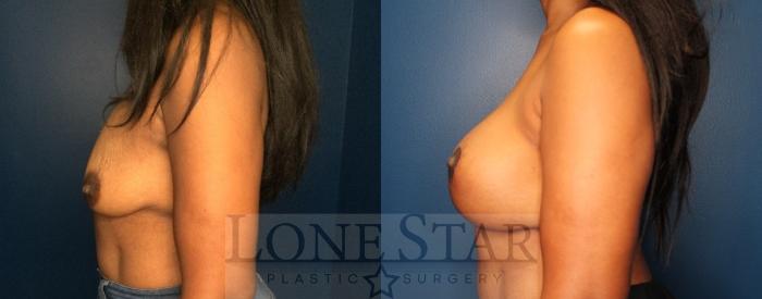 Before & After Breast Augmentation Case 170 Left Side View in Frisco, TX