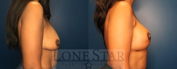 Before & After Breast Lift Case 170 Right Side View in Frisco, TX