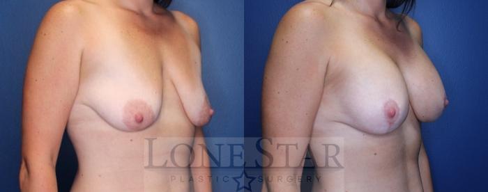 Before & After Breast Augmentation with Lift Case 172 Right Oblique View in Frisco, TX