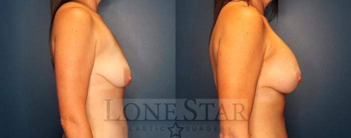 Before & After Breast Augmentation Case 172 Right Side View in Frisco, TX