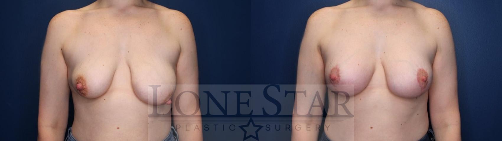 Before & After Breast Augmentation with Lift Case 173 Front View in Frisco, TX