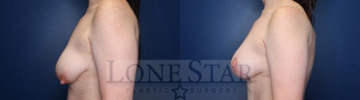 Before & After Breast Augmentation Case 173 Left Side View in Frisco, TX