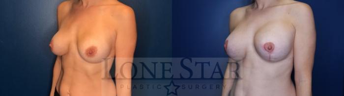 Before & After Breast Augmentation Case 179 Left Oblique View in Frisco, TX