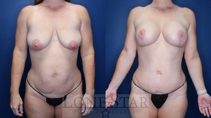 Before & After Breast Augmentation with Lift Case 182 Front View in Frisco, TX