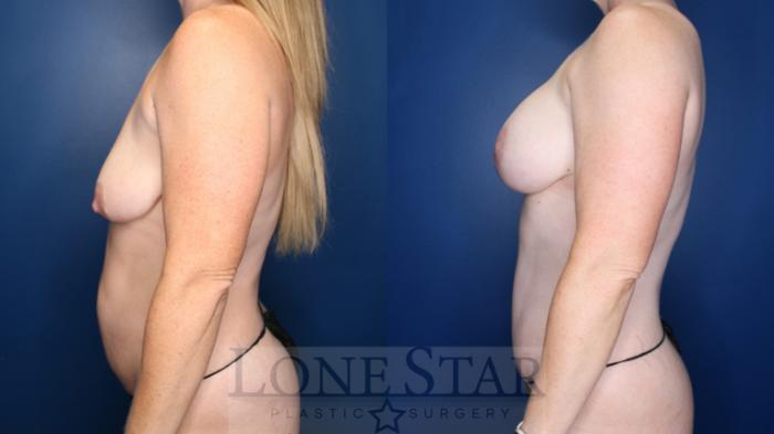 Before & After Breast Augmentation with Lift Case 182 Left Side View in Frisco, TX