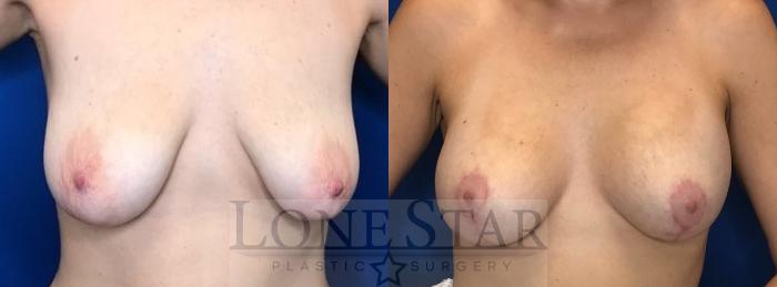 Before & After Breast Augmentation with Lift Case 42 View #1 View in Frisco, TX