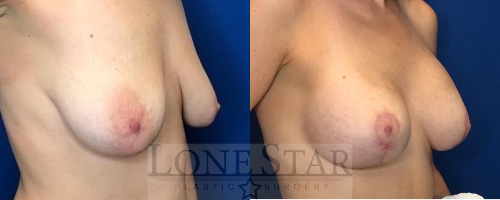 Before & After Breast Augmentation with Lift Case 42 View #2 View in Frisco, TX
