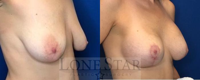 Before & After Breast Augmentation with Lift Case 42 View #2 View in Frisco, TX