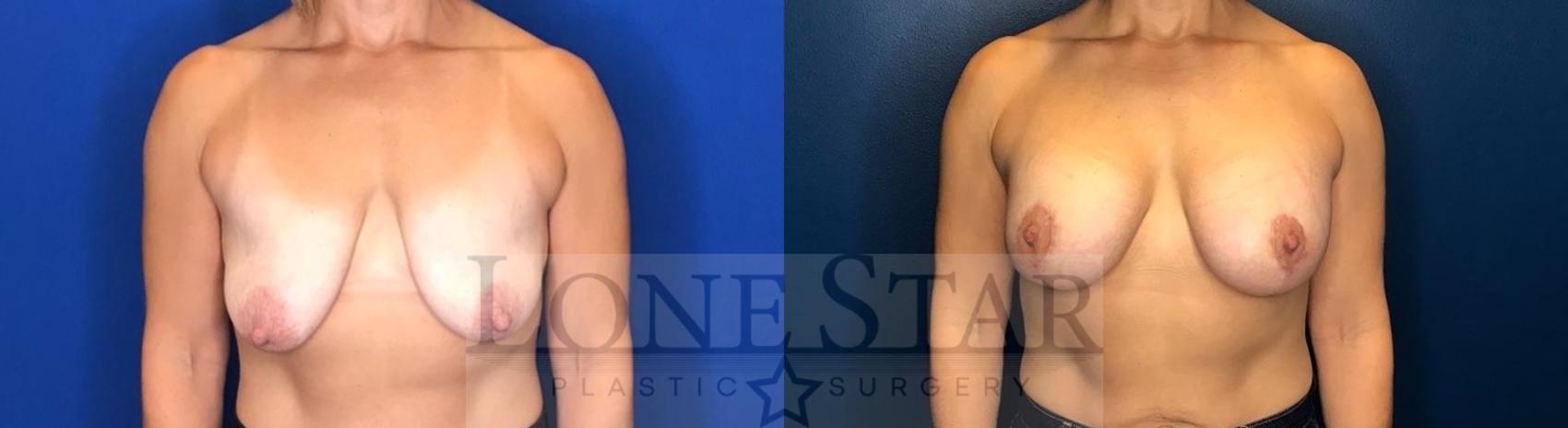 Before & After Breast Augmentation with Lift Case 60 Front View in Frisco, TX