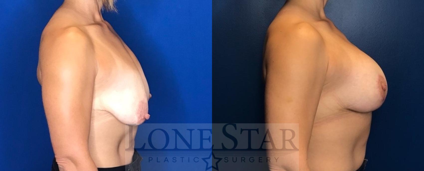 Before & After Breast Augmentation with Lift Case 60 Right Side View in Frisco, TX