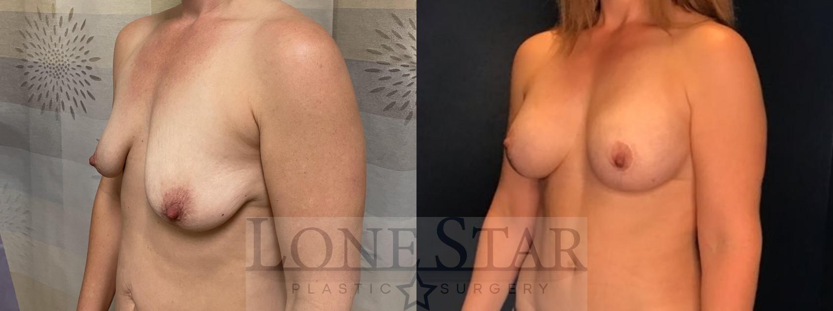 Before & After Breast Augmentation with Lift Case 81 Left Oblique View in Frisco, TX