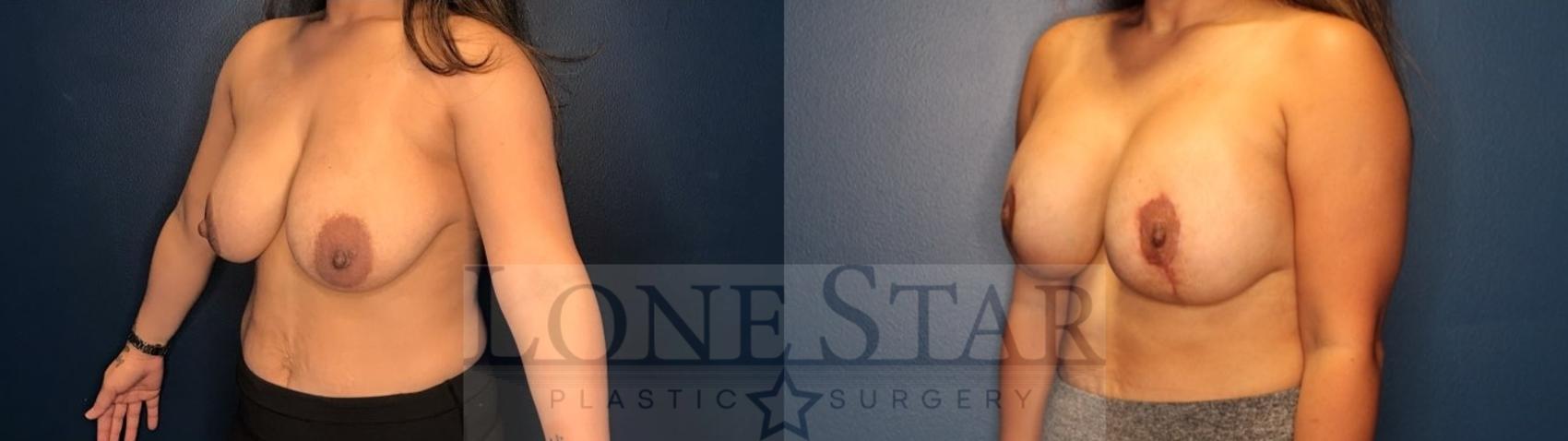 Before & After Breast Augmentation with Lift Case 84 Left Oblique View in Frisco, TX