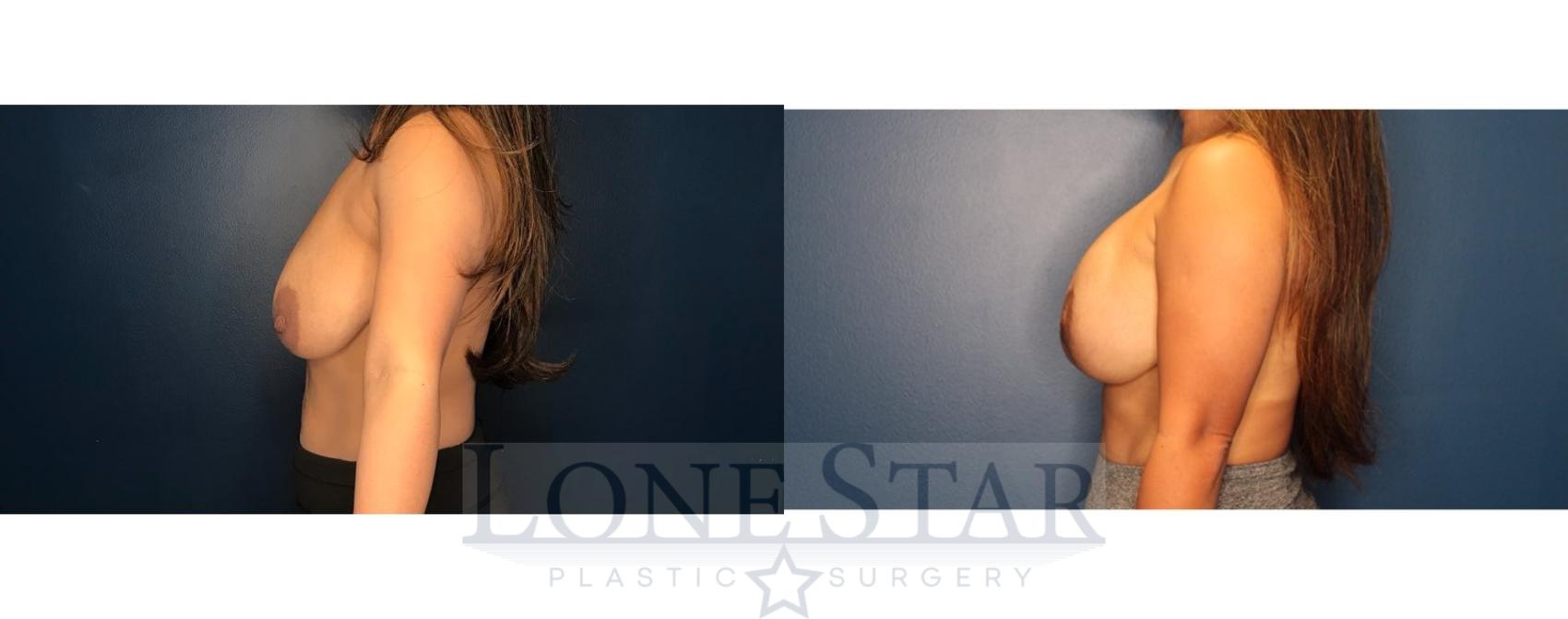 Before & After Breast Augmentation with Lift Case 84 Left Side View in Frisco, TX