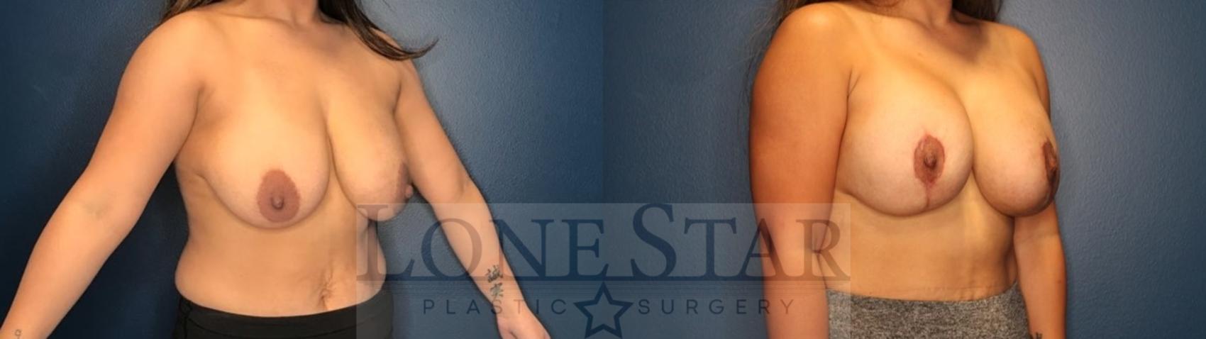 Before & After Breast Augmentation with Lift Case 84 Right Oblique View in Frisco, TX