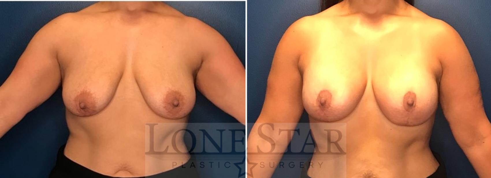 Before & After Breast Augmentation with Lift Case 88 Front View in Frisco, TX