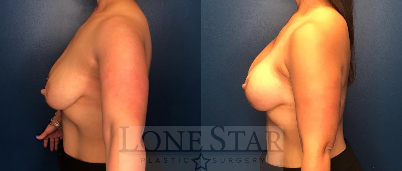 Before & After Breast Augmentation with Lift Case 88 Left Side View in Frisco, TX