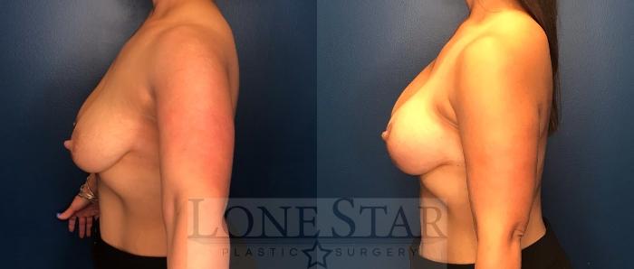 Before & After Breast Augmentation with Lift Case 88 Left Side View in Frisco, TX