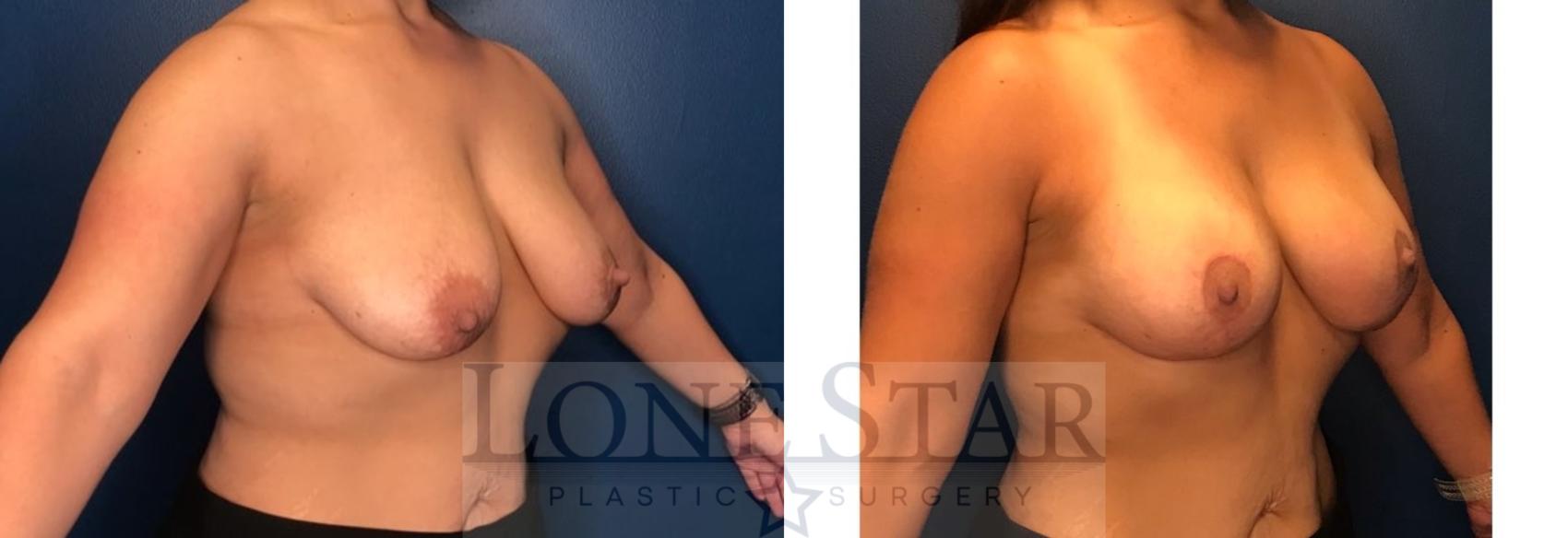 Before & After Breast Augmentation with Lift Case 88 Right Oblique View in Frisco, TX