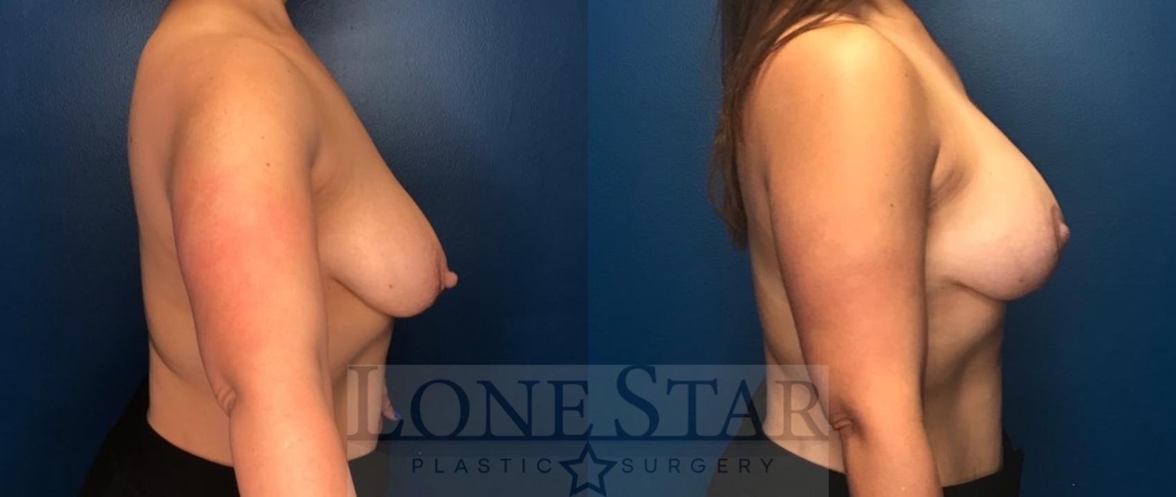 Before & After Breast Augmentation with Lift Case 88 Right Side View in Frisco, TX