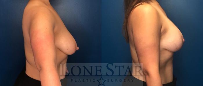 Before & After Breast Augmentation with Lift Case 88 Right Side View in Frisco, TX