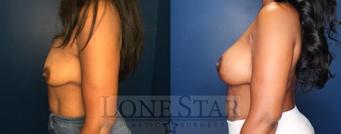 Before & After Breast Augmentation with Lift Case 89 Left Side View in Frisco, TX