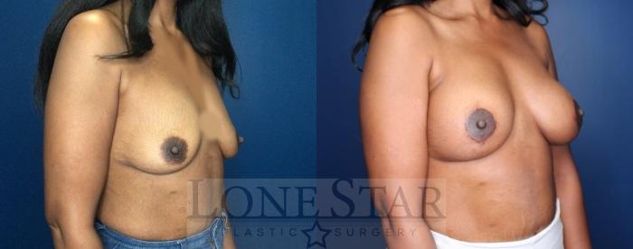 Before & After Breast Augmentation with Lift Case 89 Right Oblique View in Frisco, TX