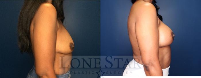 Before & After Breast Augmentation with Lift Case 89 Right Side View in Frisco, TX