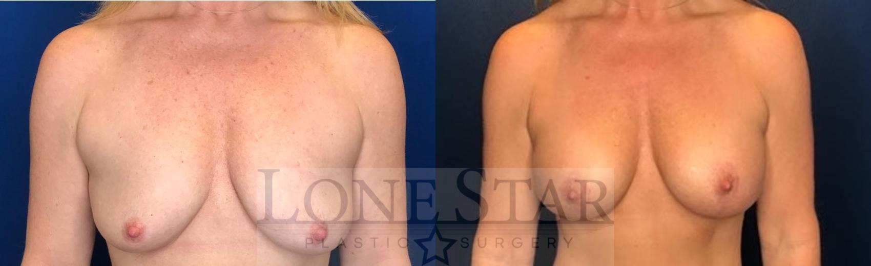 Before & After Breast Augmentation with Lift Case 93 Front View in Frisco, TX