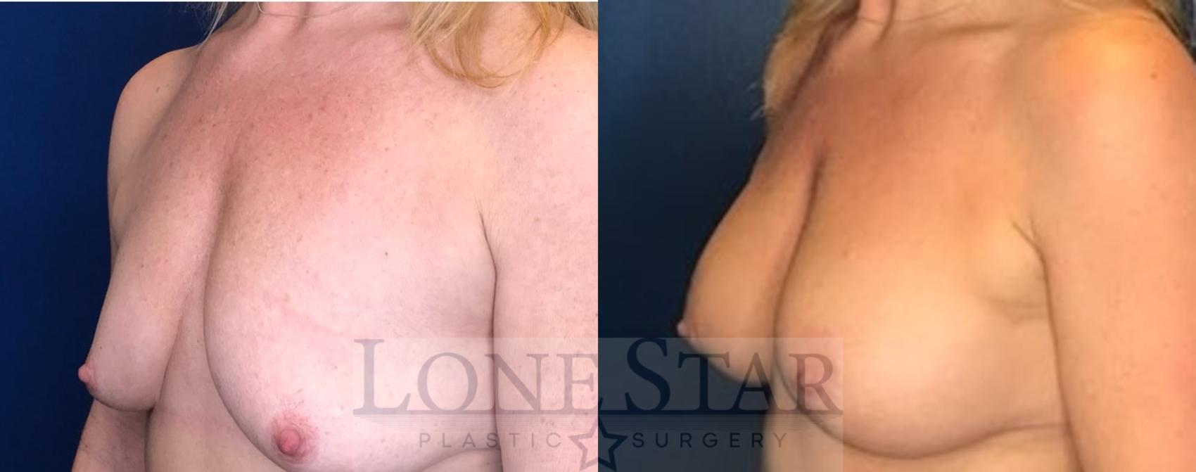 Before & After Breast Augmentation with Lift Case 93 Left Oblique View in Frisco, TX