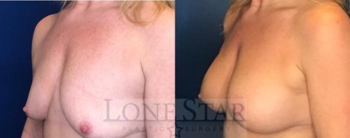 Before & After Breast Augmentation with Lift Case 93 Left Oblique View in Frisco, TX
