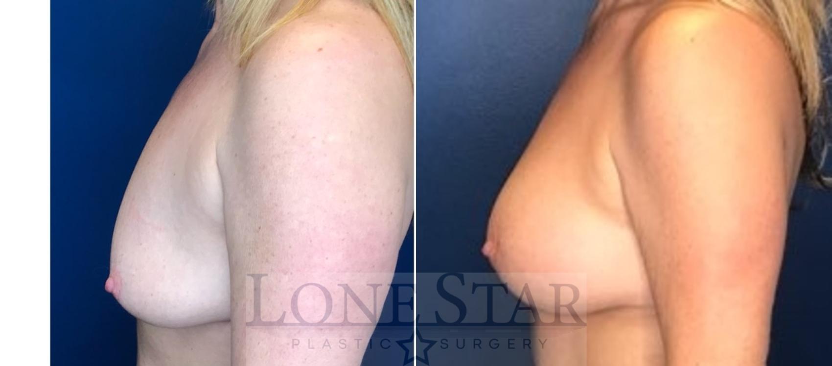 Before & After Breast Augmentation with Lift Case 93 Left Side View in Frisco, TX