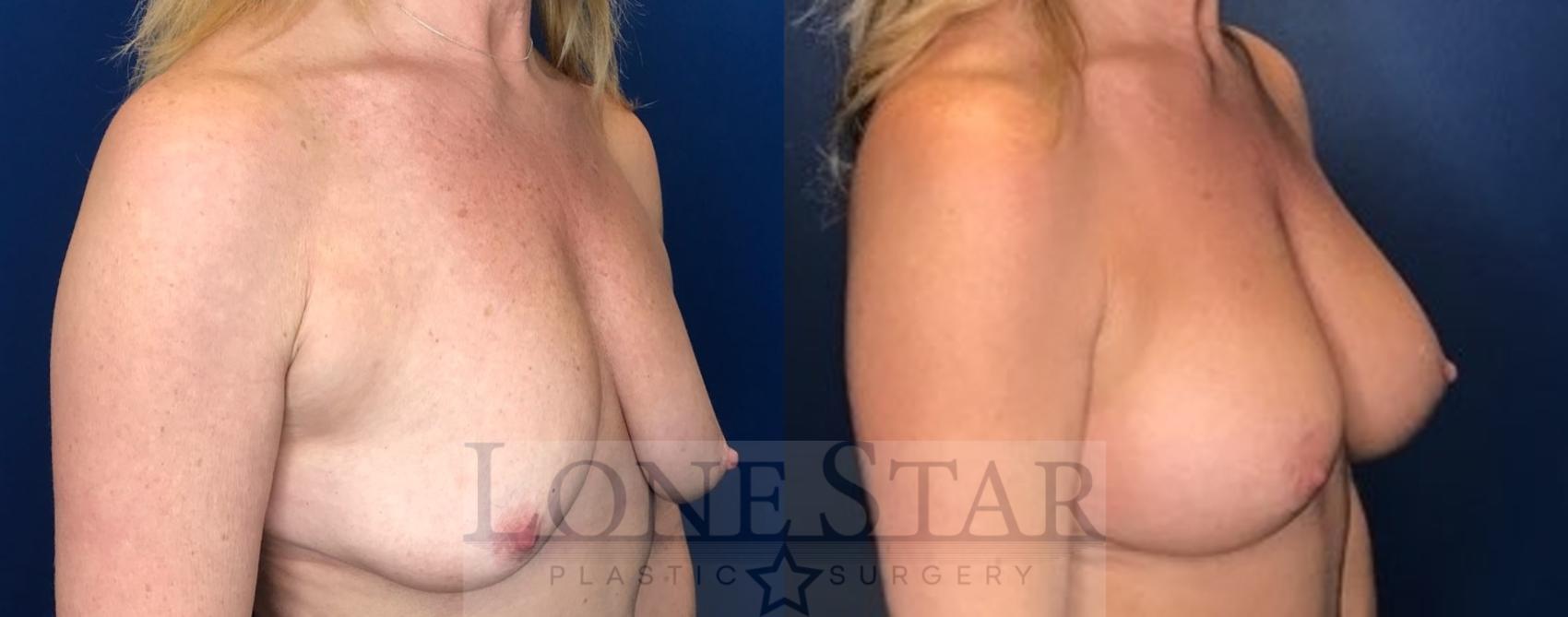 Before & After Breast Augmentation with Lift Case 93 Right Oblique View in Frisco, TX