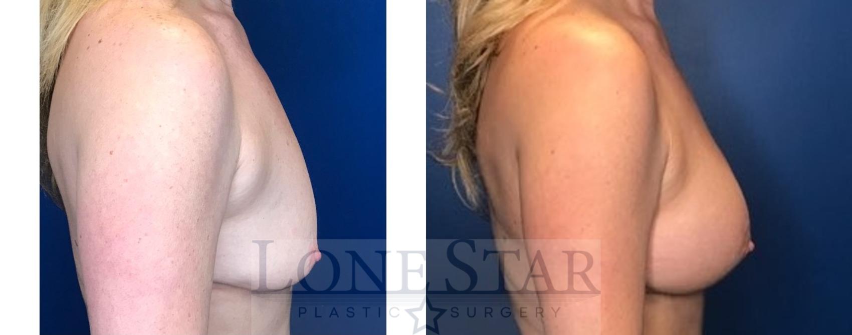 Before & After Breast Augmentation with Lift Case 93 Right Side View in Frisco, TX