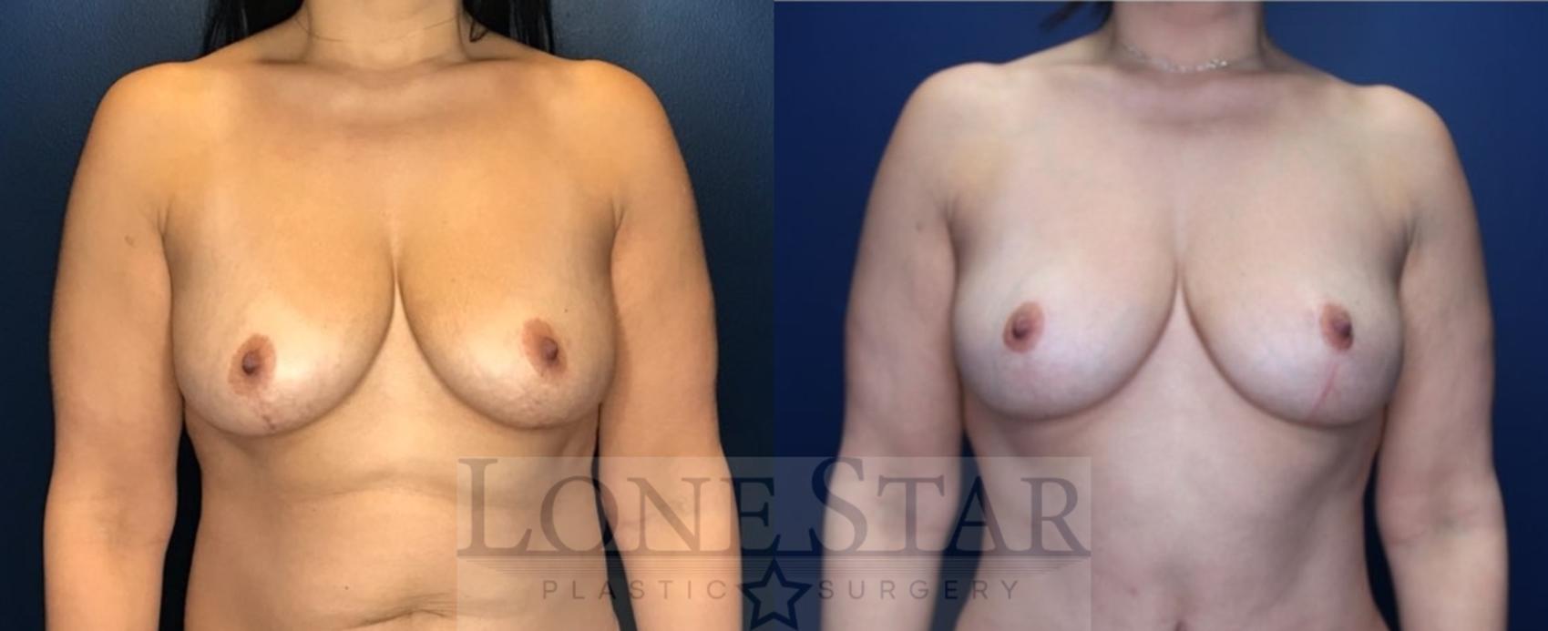 Before & After Breast Lift Case 160 Front View in Frisco, TX