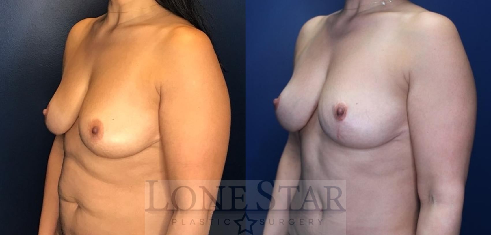 Before & After Breast Lift Case 160 Left Oblique View in Frisco, TX