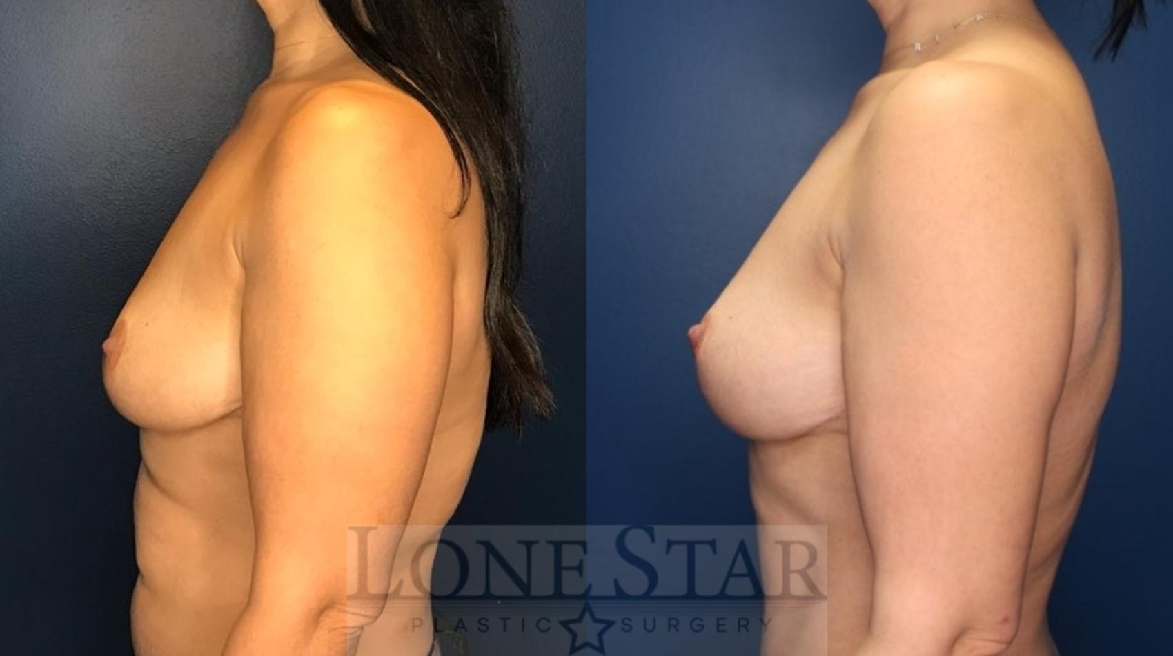 Before & After Breast Lift Case 160 Left Side View in Frisco, TX