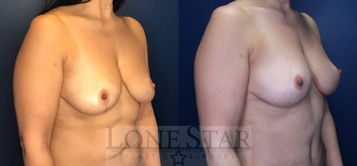 Before & After Breast Lift Case 160 Right Oblique View in Frisco, TX