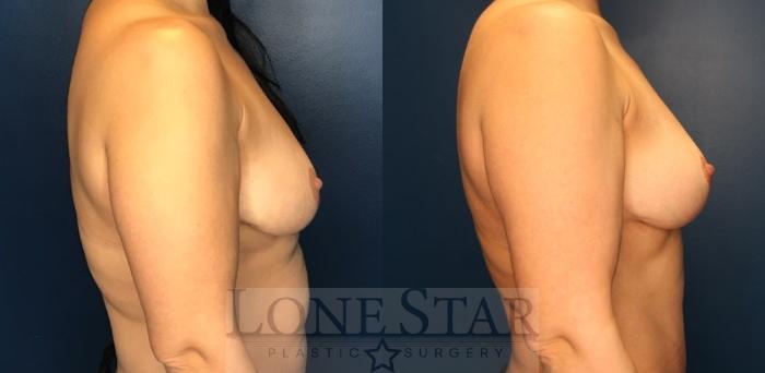 Before & After Breast Lift Case 160 Right Side View in Frisco, TX