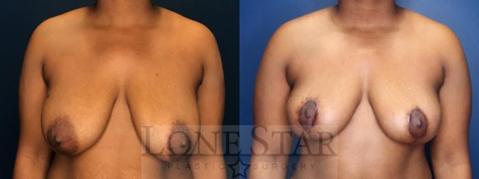 Before & After Breast Lift Case 181 Front View in Frisco, TX