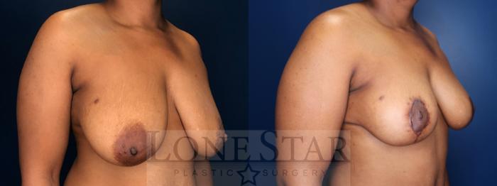 Before & After Breast Lift Case 181 Left Oblique View in Frisco, TX
