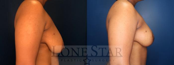 Before & After Breast Reduction Case 181 Left Side View in Frisco, TX