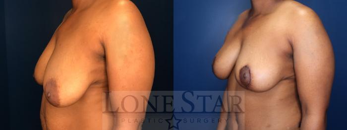 Before & After Breast Reduction Case 181 Right Oblique View in Frisco, TX