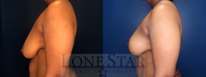 Before & After Breast Reduction Case 181 Right Side View in Frisco, TX