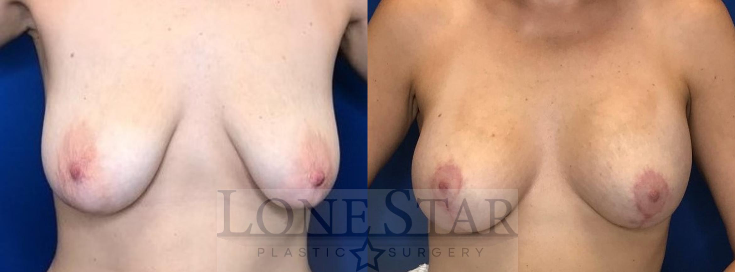Before & After Breast Lift Case 42 View #1 View in Frisco, TX