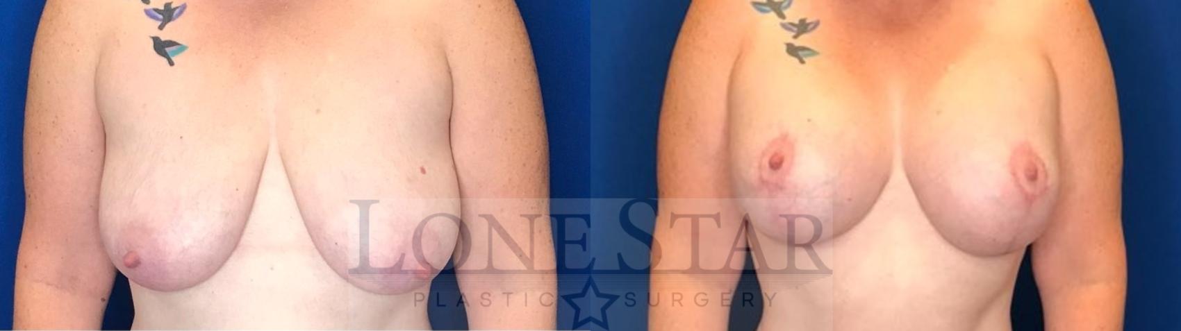 Before & After Breast Lift Case 46 Front View in Frisco, TX